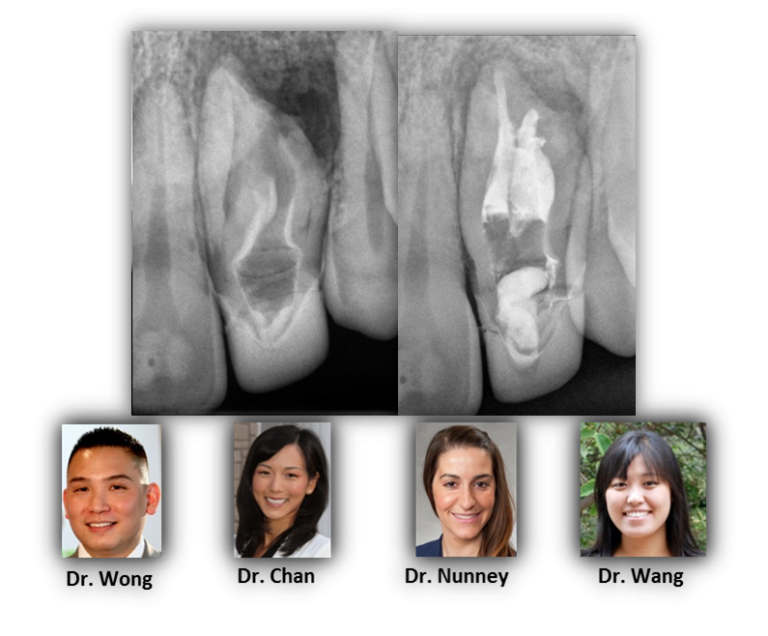 Dens In Dente Renovo Endodontic Studio