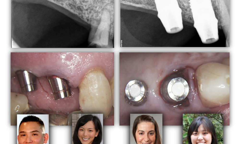 Extraction & Dental Implants Renovo Endodontic Studio
