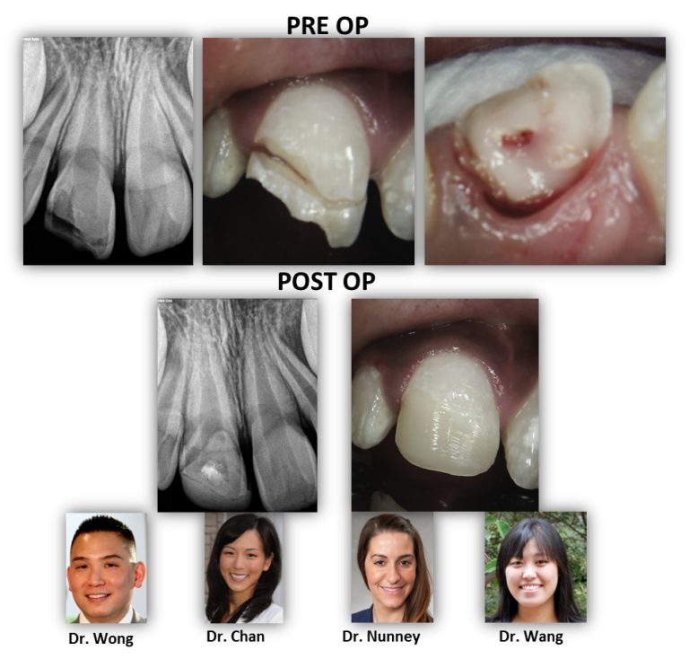Dental Trauma Preserving Healthy Pulp Tissue Renovo Endodontic Studio
