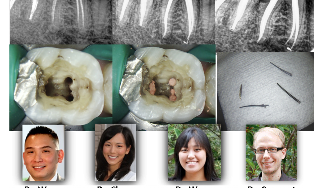 X-rays and images of a root canal retreatment
