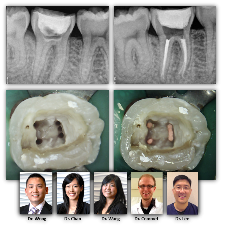 X-rays and images of a 5 canal lower molar