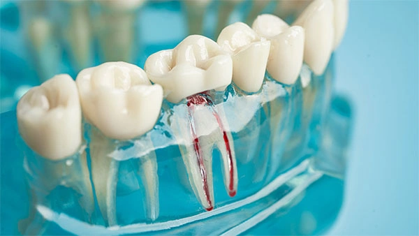 Dental-model-showing-root-structure-and-invasive-cervical-resorption-1