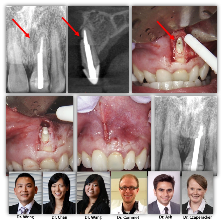 non-restorable-root-fracture
