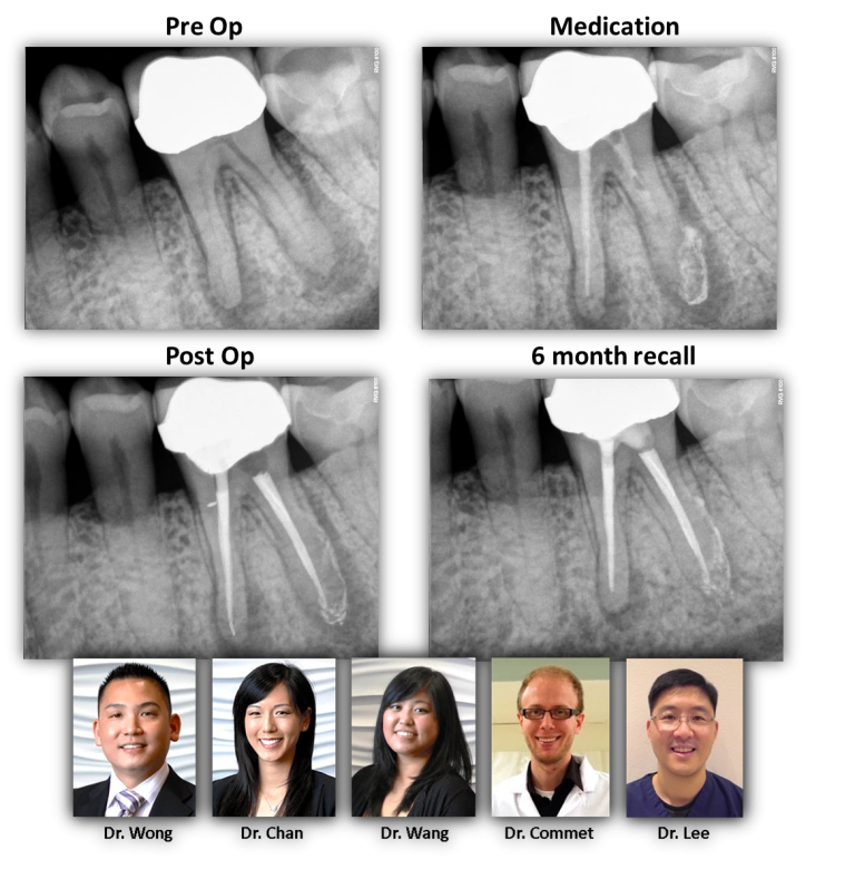 saved-tooth