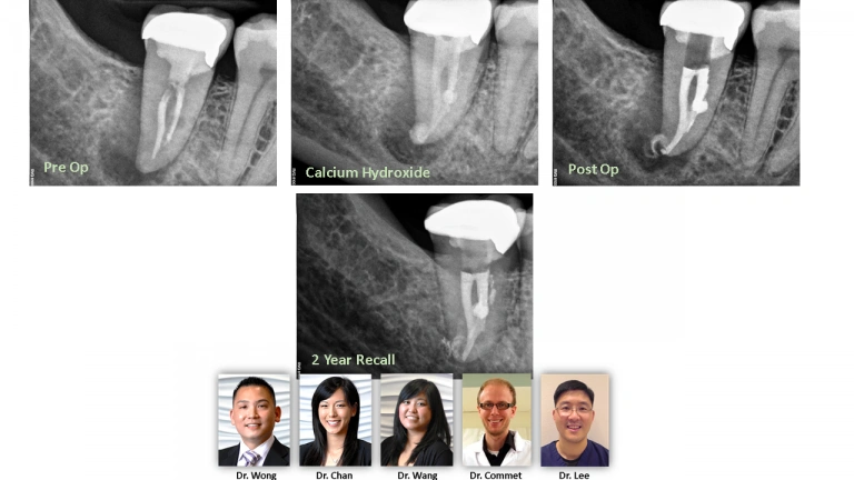 tooth-post-op