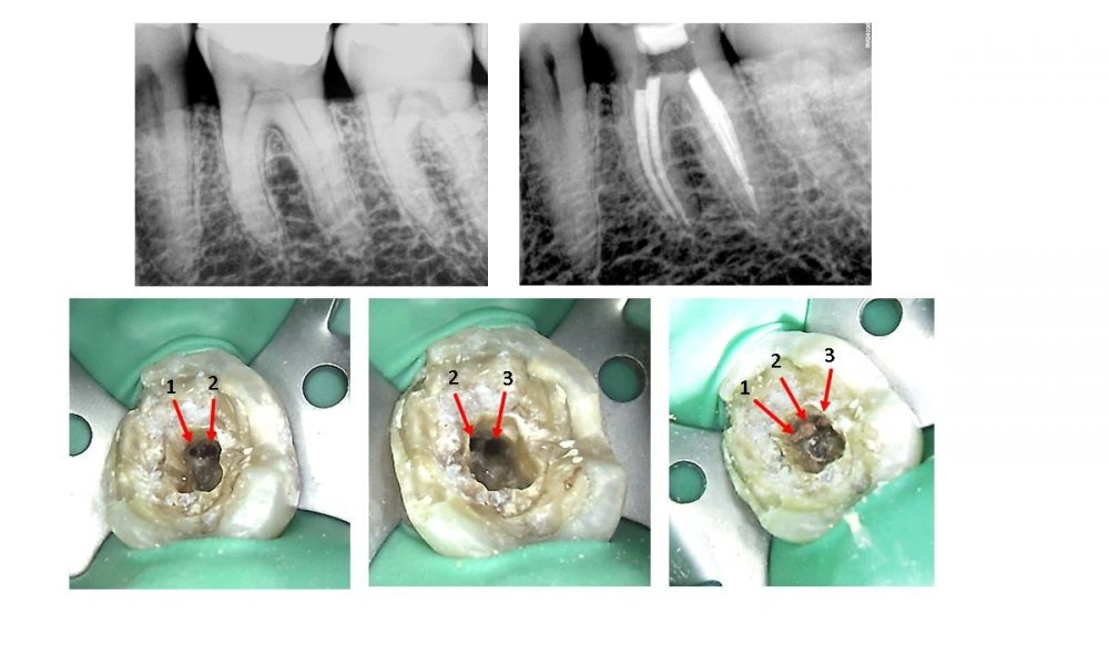 tooth-repair