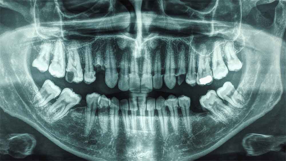 Dental X-ray showing impacted wisdom teeth and a dental filling