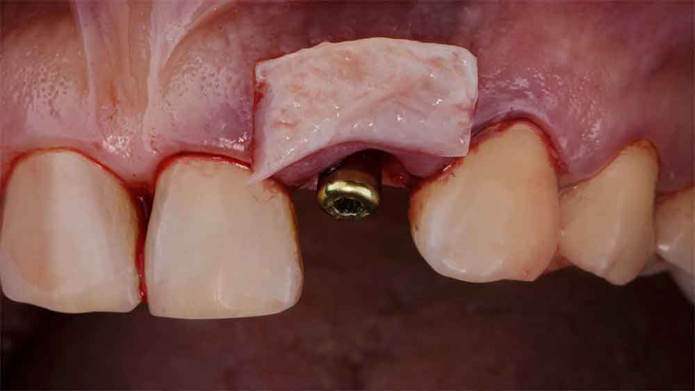 Ridge-augmentation-procedure-with-a-bone-graft-over-a-dental-implant