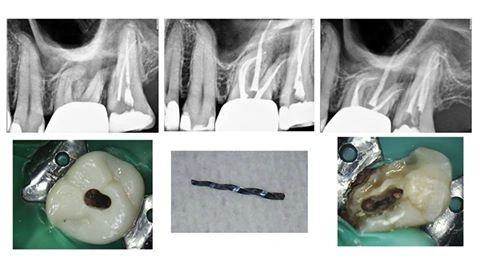 endodontic-complication
