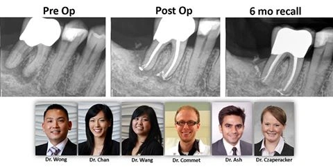 endoperio-lesion
