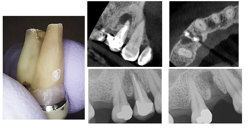 root-fracture