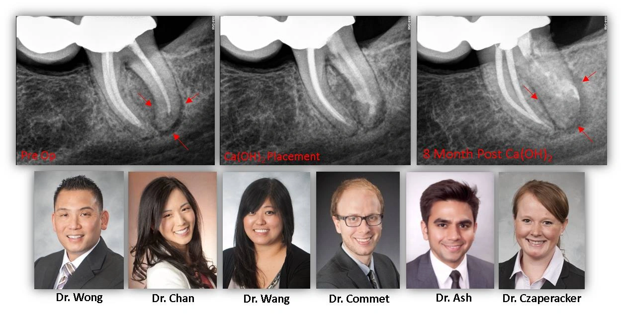 Vertical-root-fracture
