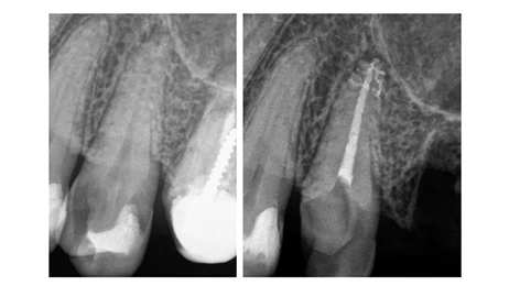 apical-delta