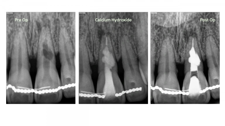 complex-resorption-image
