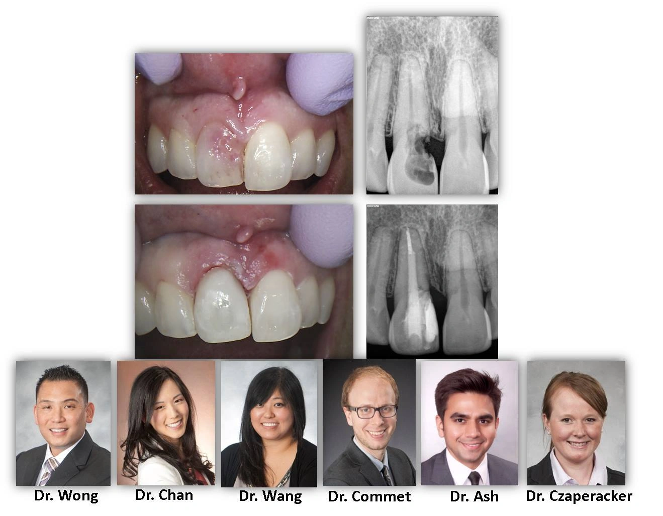 tooth-reapsorption