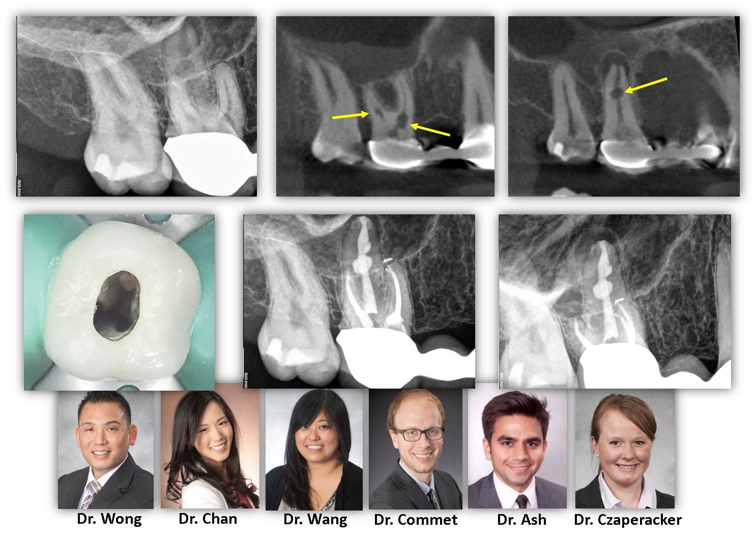 CBCT and Resorption
