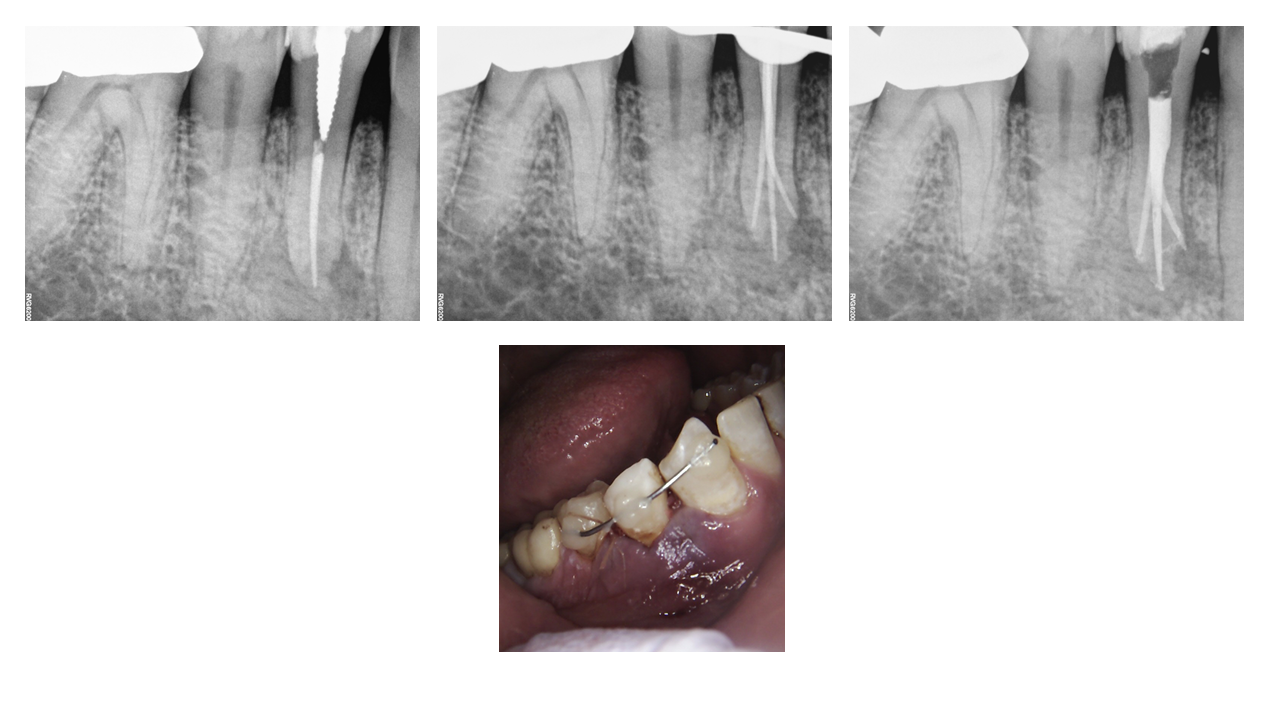 mandibular first premolars
