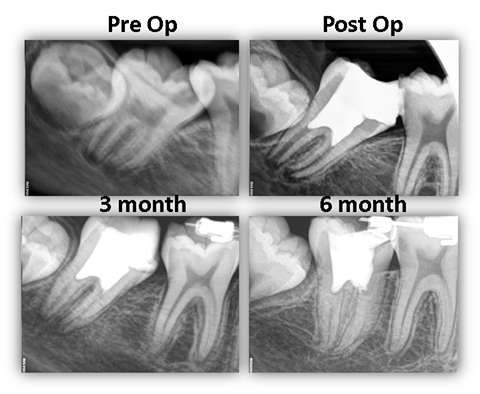 Tooth Pulp Image