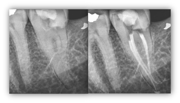 calcification tooth imaging