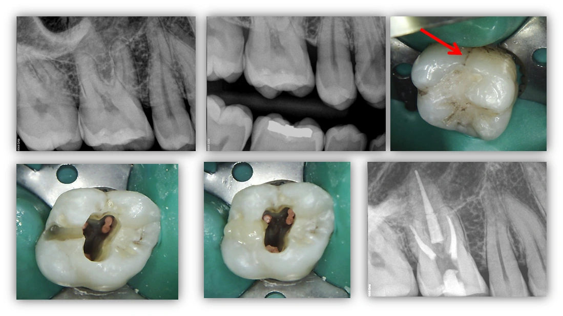 coronal-restoration-image