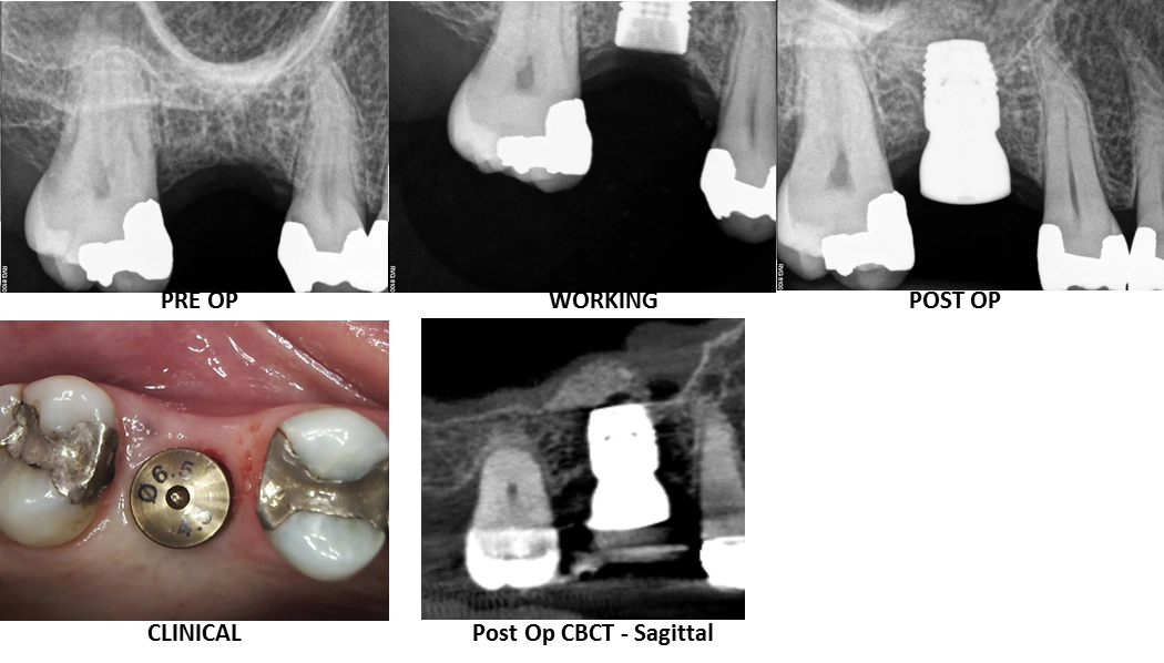endo-_-dental-implants