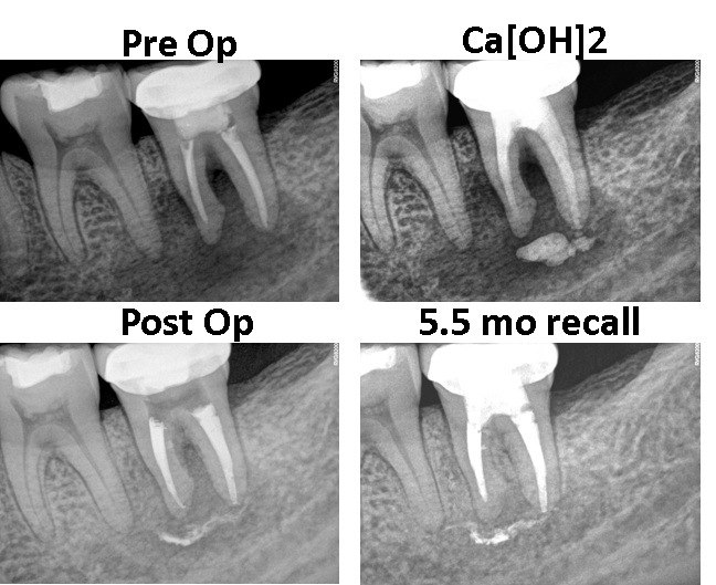 endodontic before and after