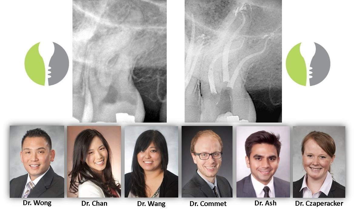 root-canal-therapy