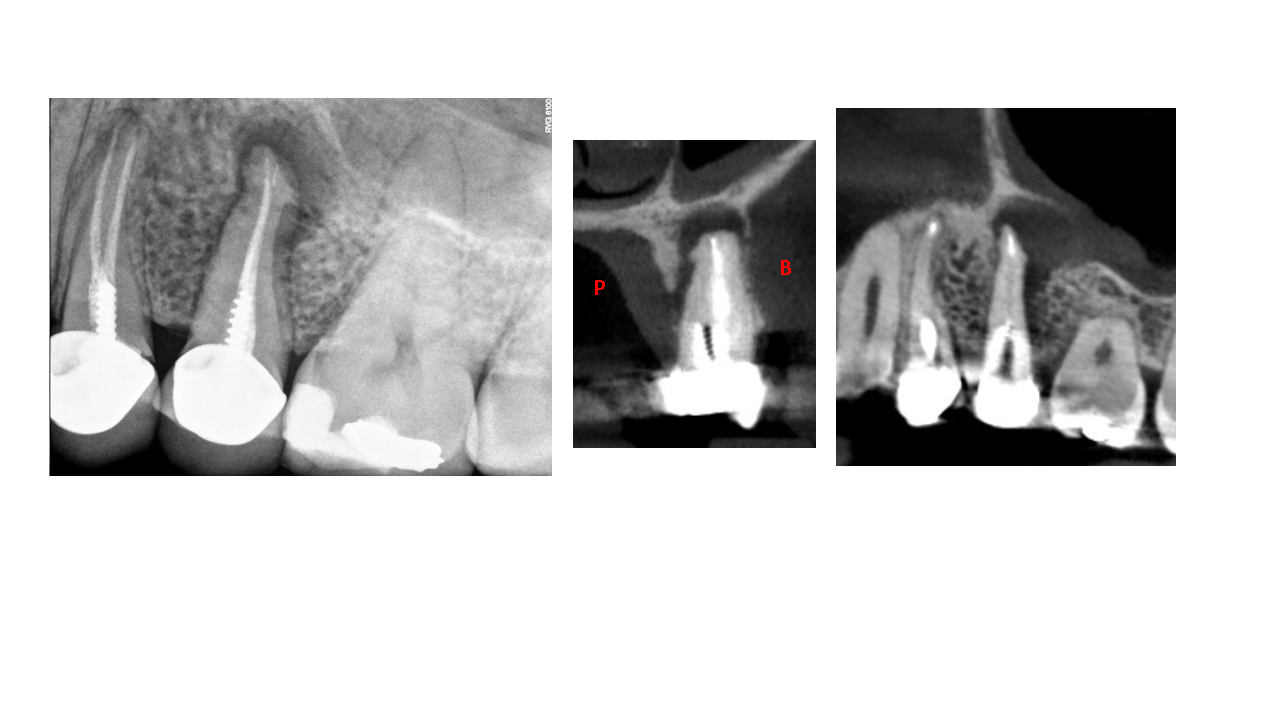 CBCT Surgical Image