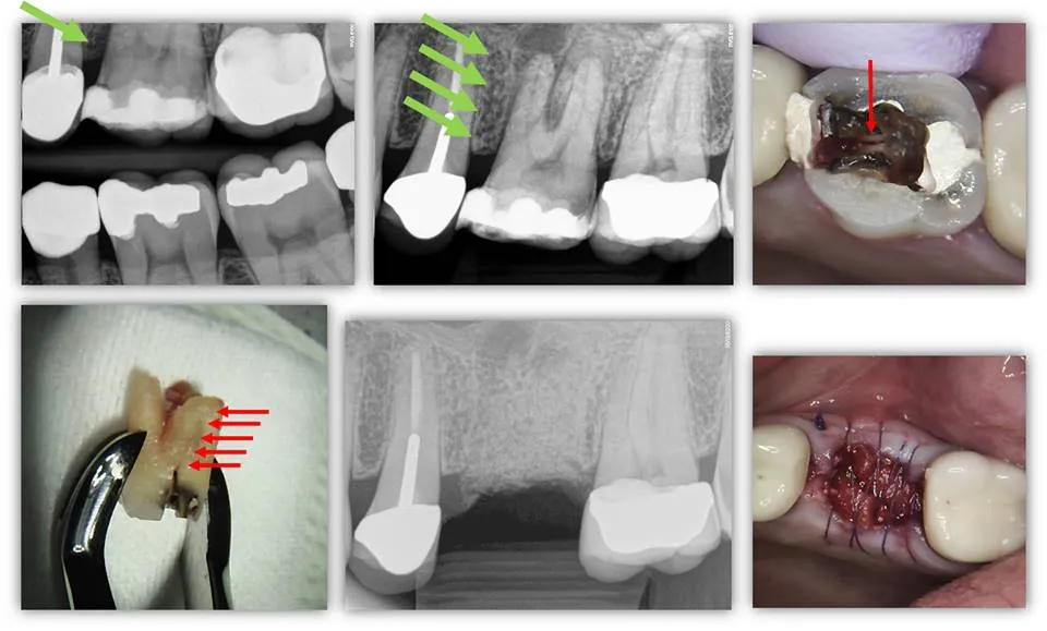 properdiagnosisofnonrestorabletoothfrac
