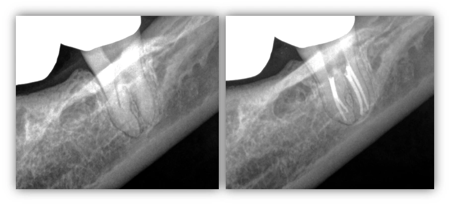third-molar-echo