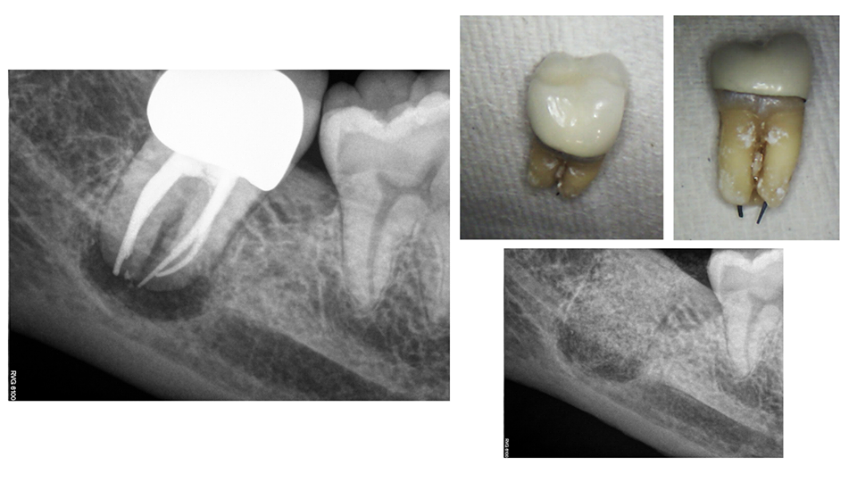 Why Does My Endodontist Sometimes Fill Short?
