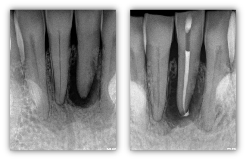 Is Complete Canal Calcification Treatable?