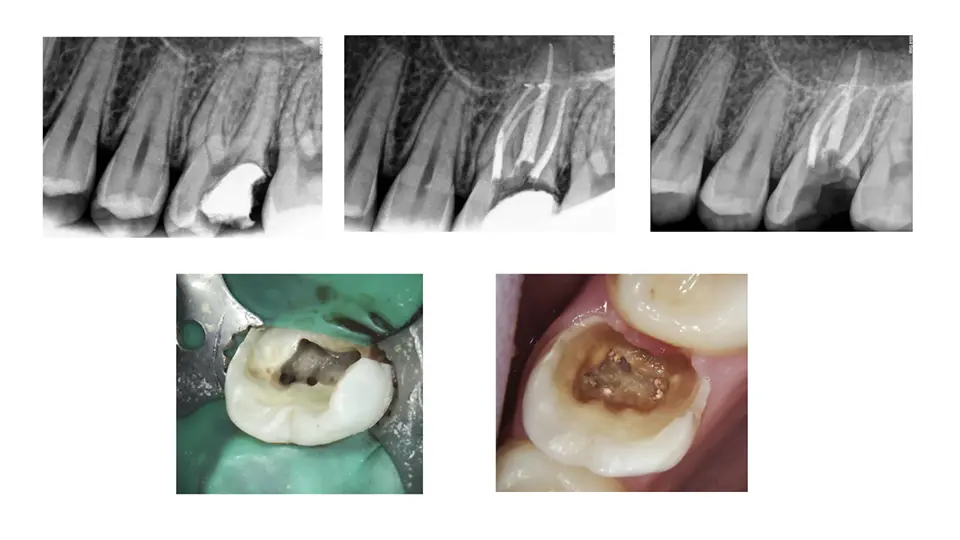 endodontistspermarestorations