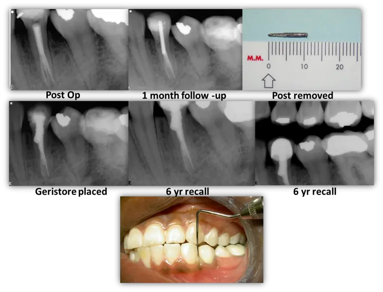 restorativecomplicatonsendotreatment