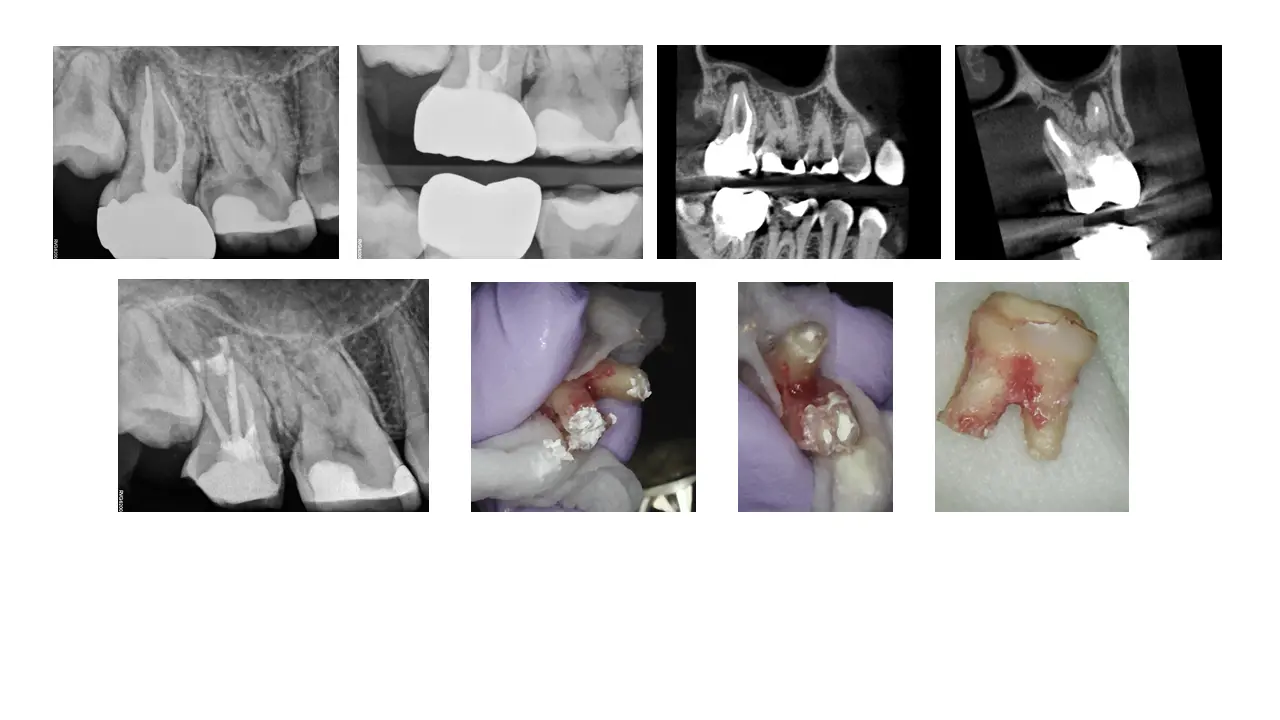 whydoesmyendodoextractions