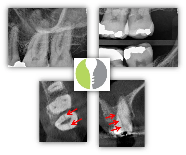 CRACK-EXTENSION-DETERMINED-BY-CBCT-Image