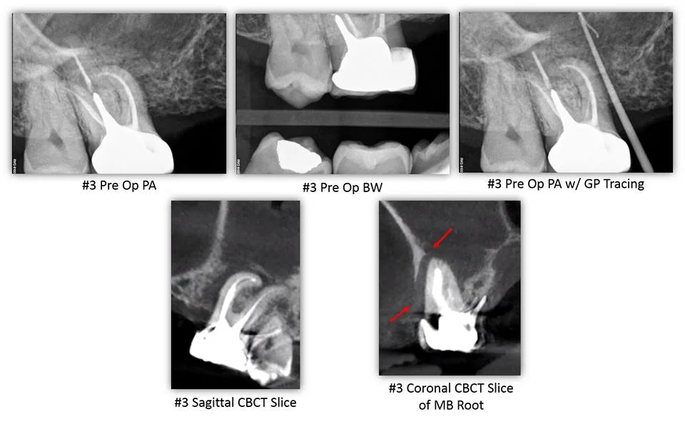 OROANTRAL-COMMUNICATION-CAUSED-BY-ODONTOGENIC-PATHOLOGY-image