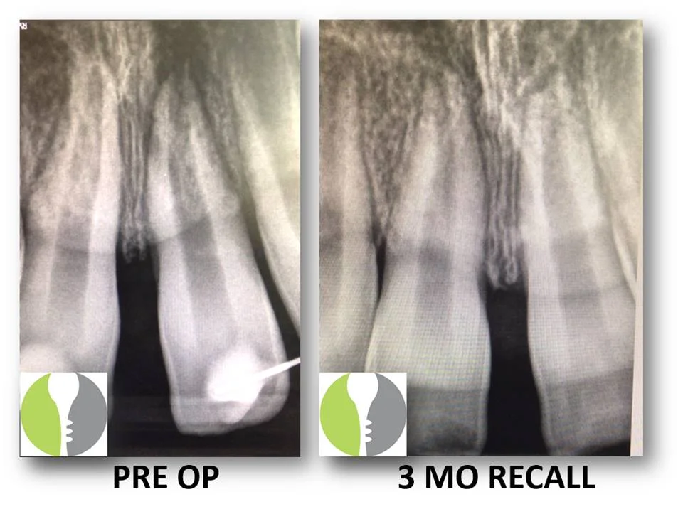 Transient-Apical-Breakdown-Image