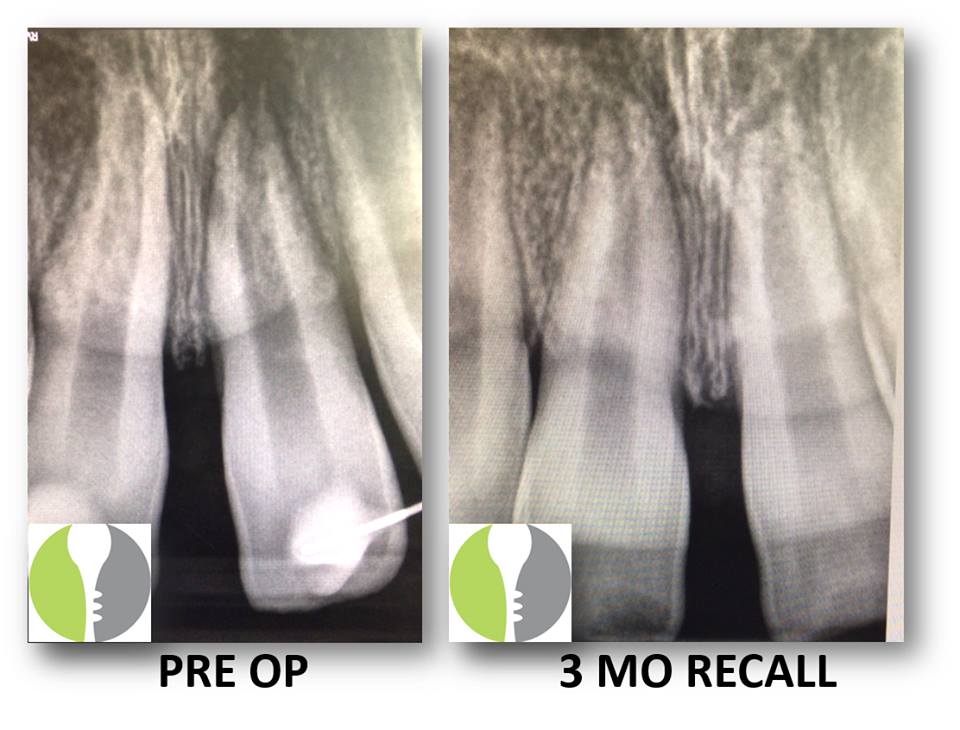 TRANSIENT APICAL BREAKDOWN | Renovo Endodontic Studio