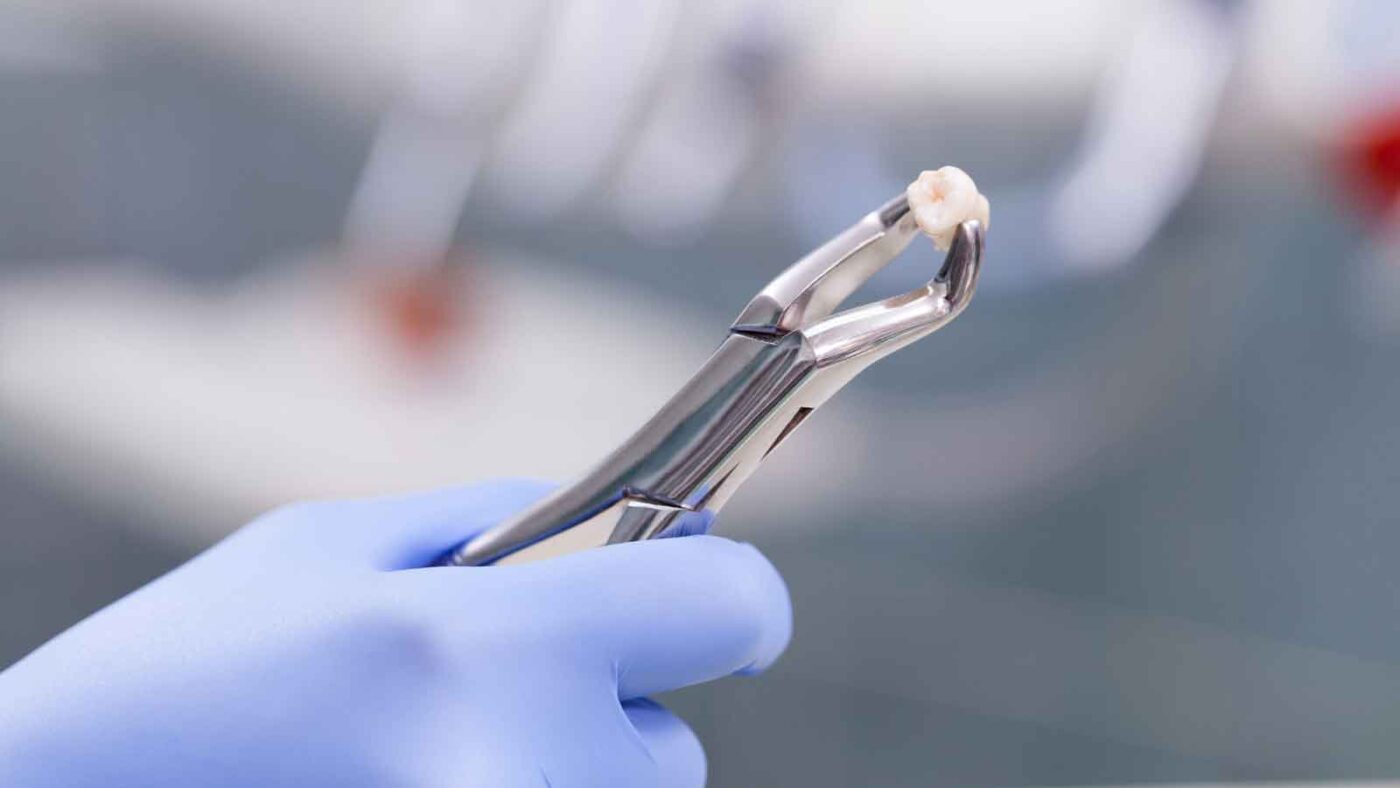  Gloved hand holding extracted tooth with dental forceps.