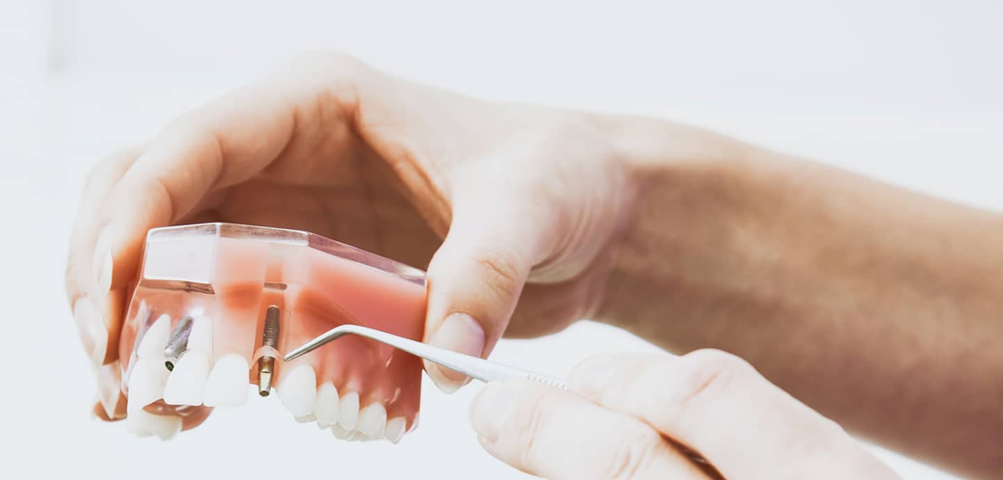 Dental Implant & Tooth Replacement Renovo Endodontics Studio