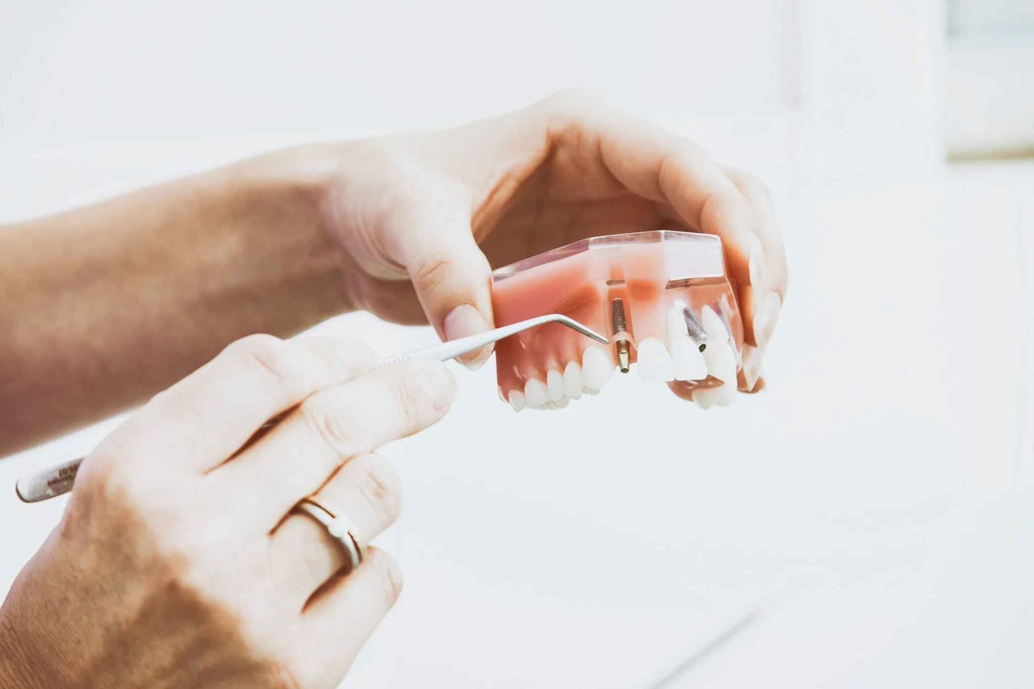 Dental-Implants-scaled