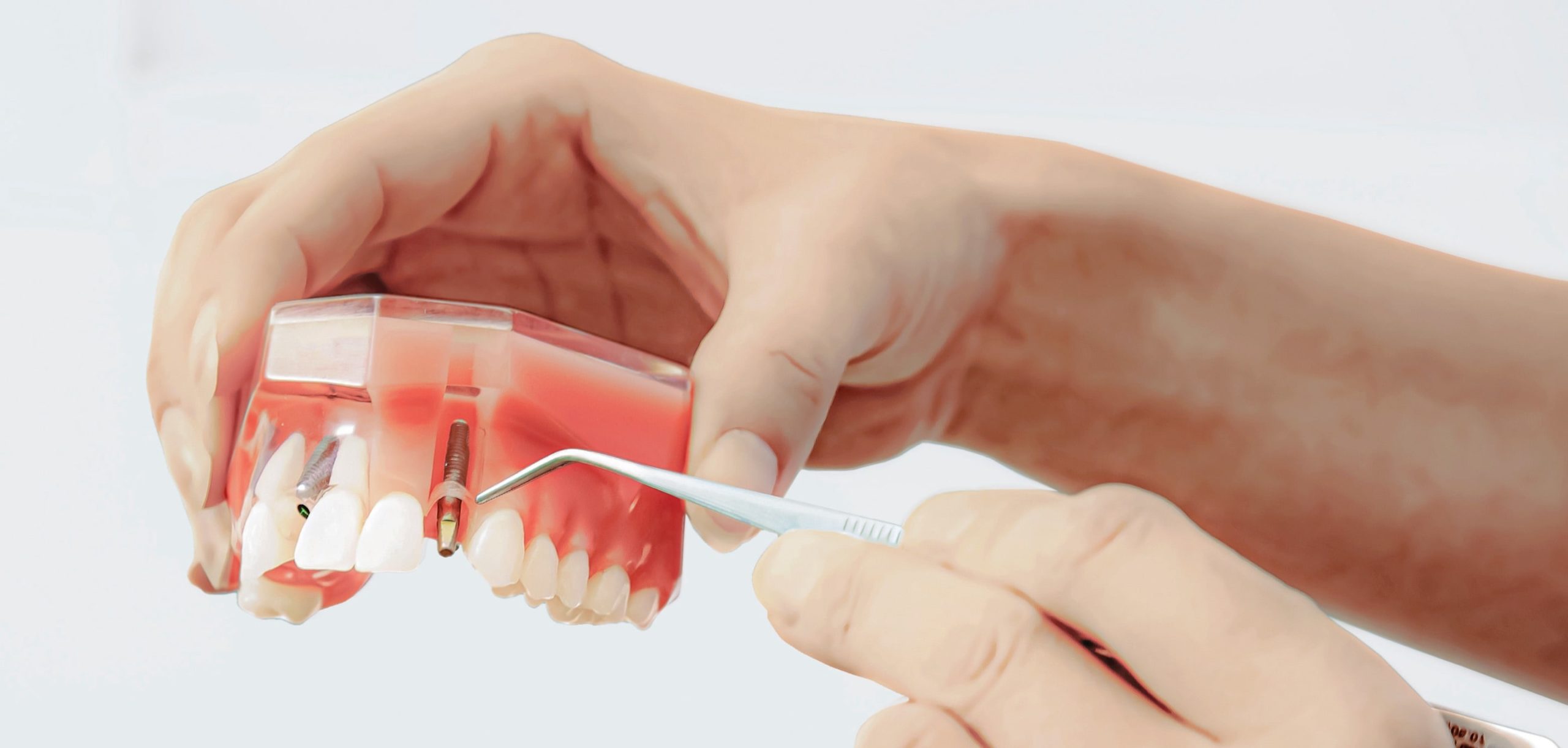 Dental Implant Hero Image