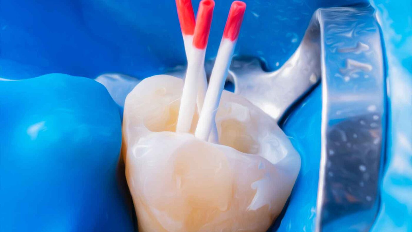 Close-up of root canal treatment in progress on a tooth.