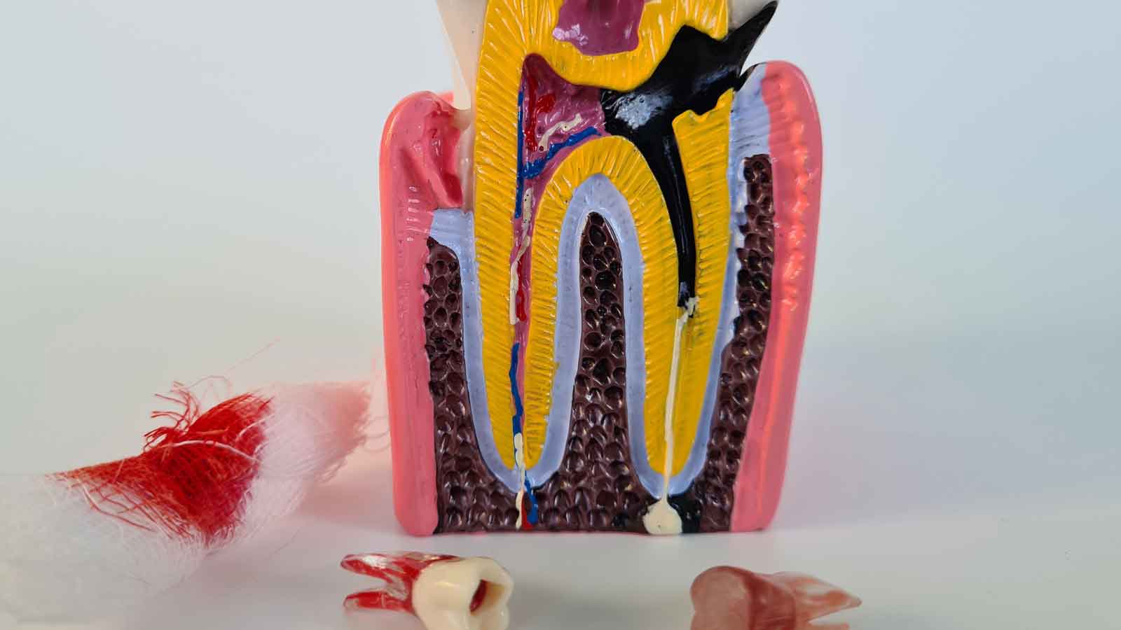 Cross-section-model-showing-an-infected-tooth-with-pulp-damage