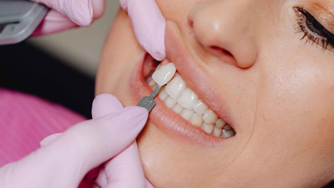 Dentist matches tooth shade using a B1 color guide.