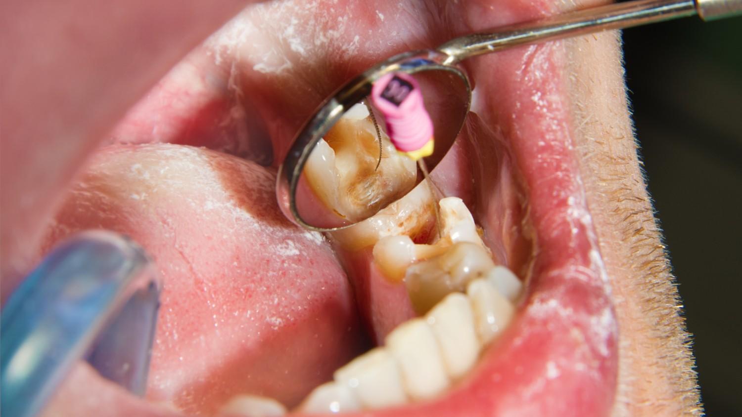 Close-upofadentistperformingarootcanaltreatmentonatoot