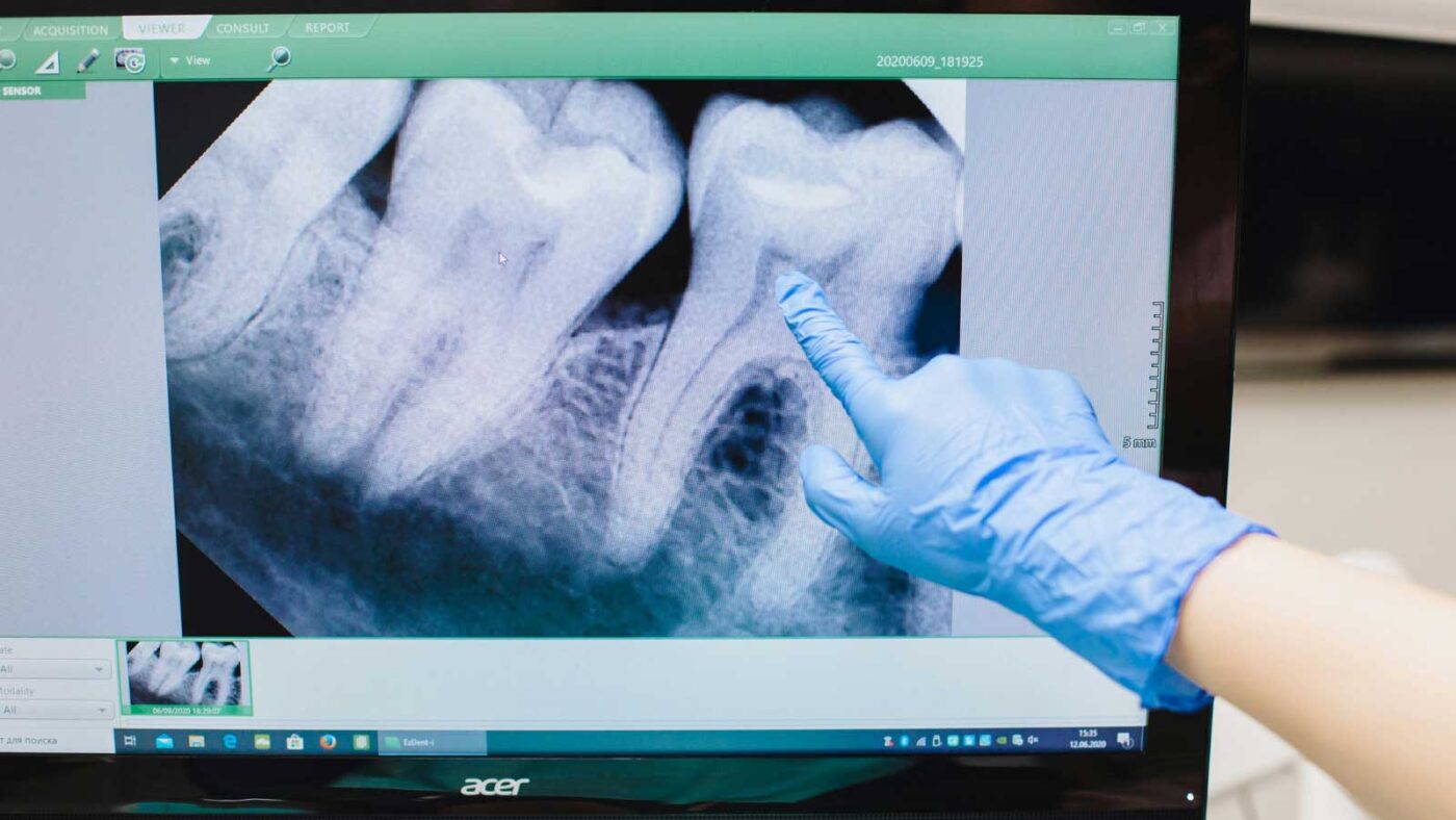 Gloved hand pointing at a tooth crack on a dental X-ray.
