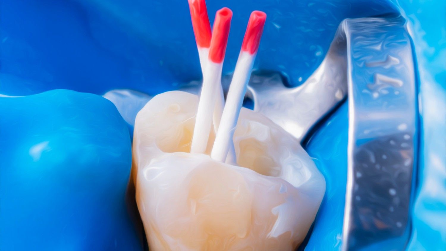 Toothwithgutta-perchapointsduringrootcanalretreatmen