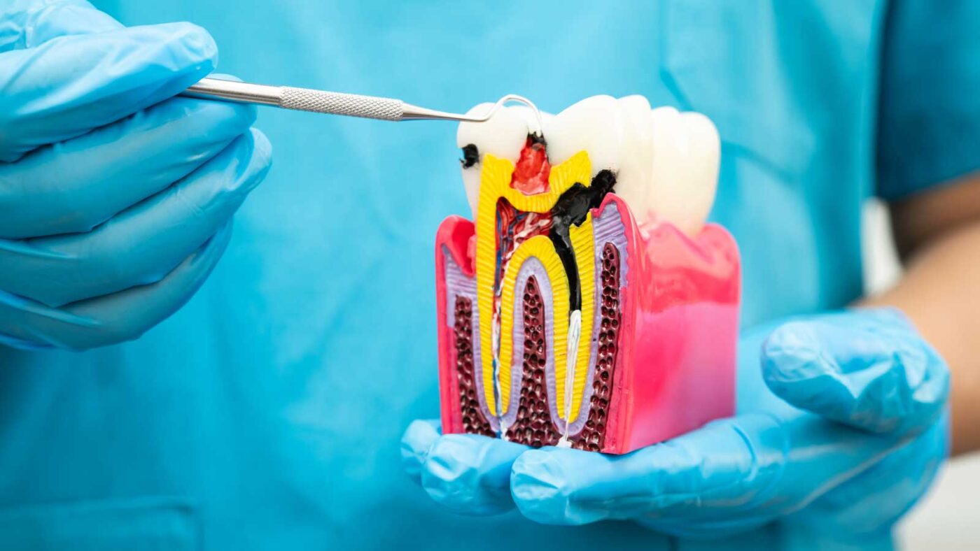 A dentist holds a tooth model showing the root canal structure.